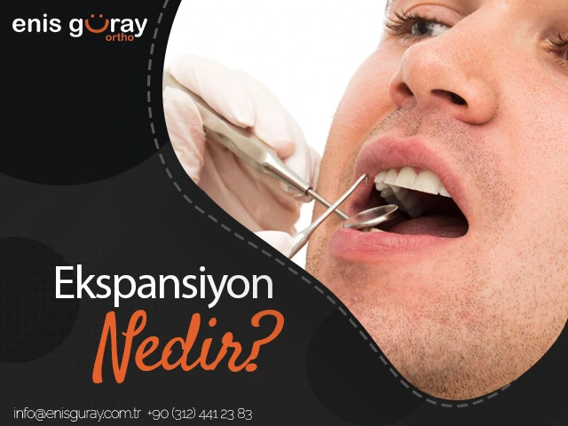 ekspansiyon-nedir