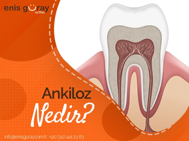 Ankiloz Nedir?