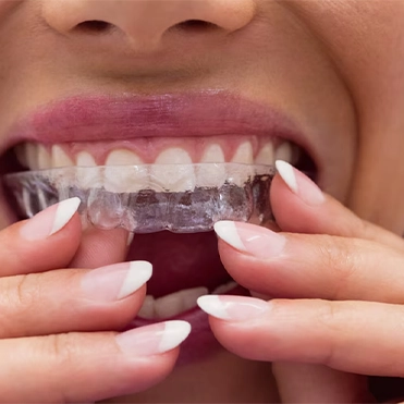 Şeffaf Plak Temizliği