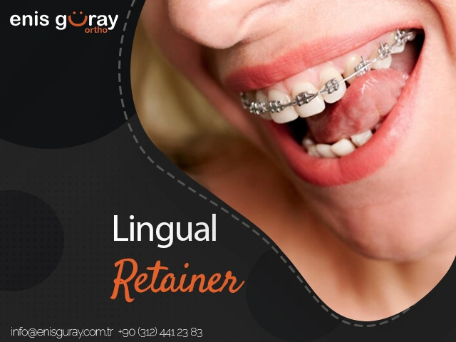 Lingual Retainer