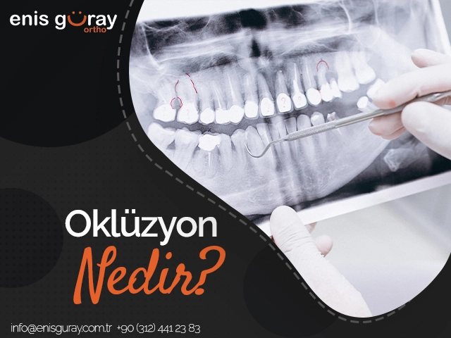 Oklüzyon Nedir?
