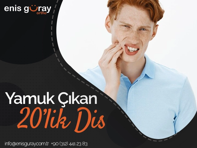 Yamuk Çıkan 20’lik Diş